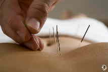 Akupunkturnadeln